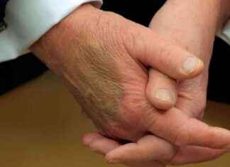 Investigation Reveals Trump’s Bruise Cause in Macron Meeting nvestigation-reveals-trumps-bruise-cause-in-macron-meeting